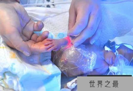 世界上最小的婴儿,五胞胎中最小孩子仅250克 世界上最小的婴儿,五胞胎中最小孩子仅250克