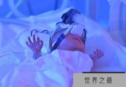 世界上最小的婴儿,五胞胎中最小孩子仅250克 世界上最小的婴儿,五胞胎中最小孩子仅250克