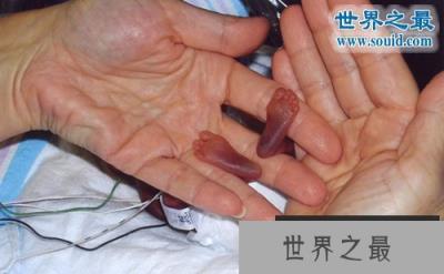 世界上最小的婴儿,五胞胎中最小孩子仅250克 世界上最小的婴儿,五胞胎中最小孩子仅250克