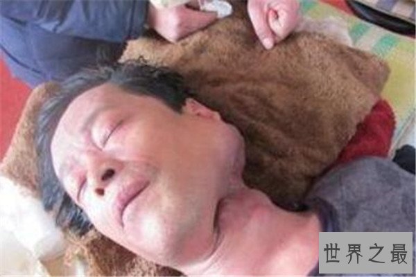 世界十大绝症 早衰基本活不过二十岁，第八高发于老人群体