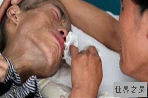 世界十大绝症 早衰基本活不过二十岁，第八高发于老人群体