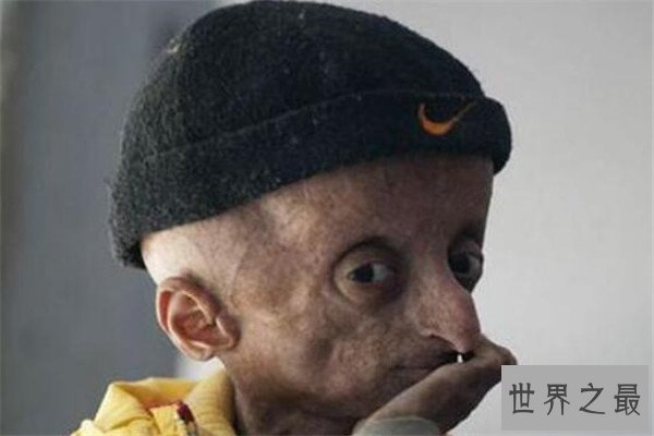 世界十大绝症 早衰基本活不过二十岁，第八高发于老人群体