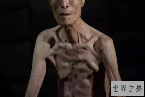 世界十大疼痛 急性阑尾炎上榜，难产疼痛指数无法估计