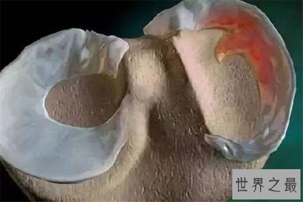 世界十大疼痛 急性阑尾炎上榜，难产疼痛指数无法估计