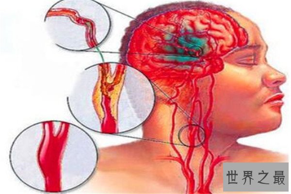 世界十大疼痛 急性阑尾炎上榜，难产疼痛指数无法估计
