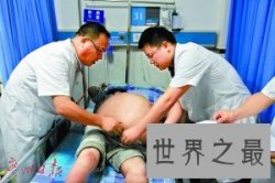 女子长世界最大肿瘤 世界最大肿瘤有多大