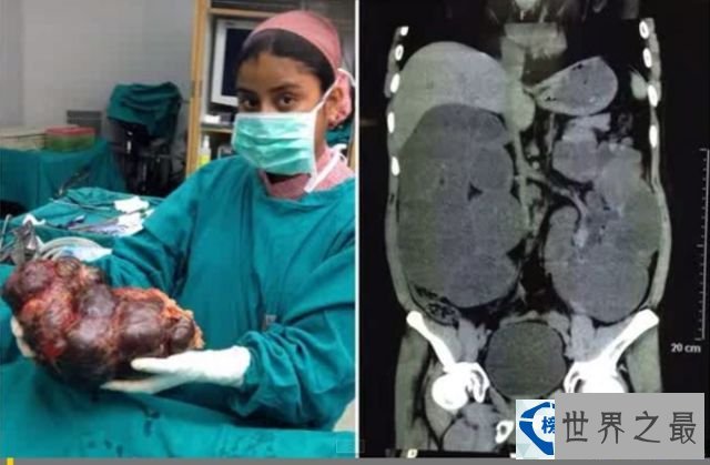 世界上最大的肾脏