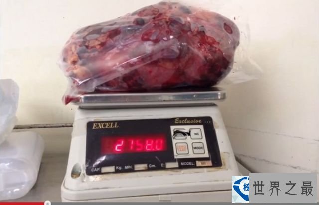 世界上最大的肾脏