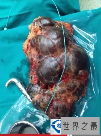 世界上最大的肾脏