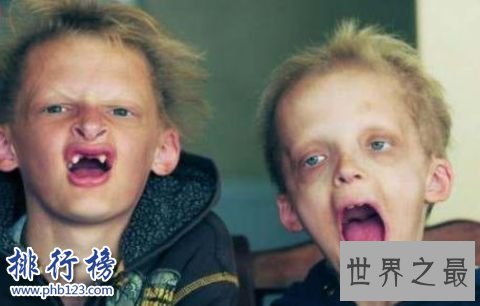 世界十大罕见病:一种变成活死人一种变成蓝血人