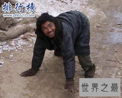 世界十大罕见病:一种变成活死人一种变成蓝血人