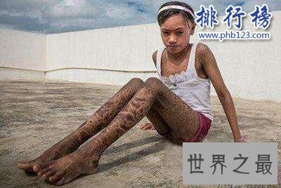 世界十大罕见病:一种变成活死人一种变成蓝血人