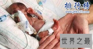 世界上最小的婴儿:体重仅200多克,小袋洗衣粉都比他重