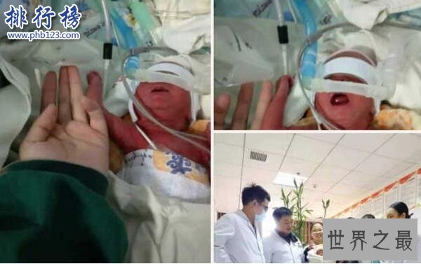 世界上最大的婴儿,出生体重36斤(母亲体重544斤)