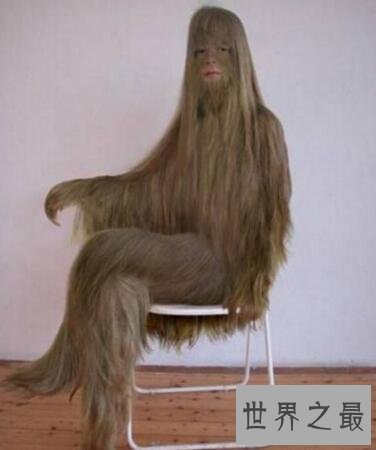 世界上最奇葩的脑袋：“半脑哥”因车祸切掉半个脑袋(侧面惊人)