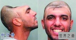 世界上最奇葩的脑袋：“半脑哥”因车祸切掉半个脑袋(侧面惊人)