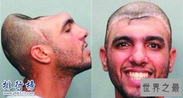 世界上最奇葩的脑袋：“半脑哥”因车祸切掉半个脑袋(侧面惊人)