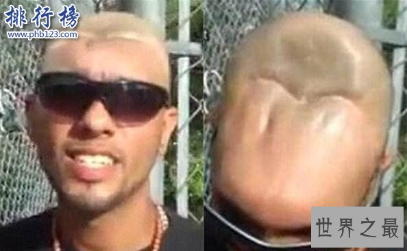 世界上最奇葩的脑袋：“半脑哥”因车祸切掉半个脑袋(侧面惊人)