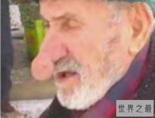 世界上最大的鼻子：土耳其老人鼻子长14厘米