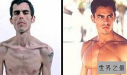 世界上最瘦的男人，患厌食症体重仅41公斤（瘦成竹竿）