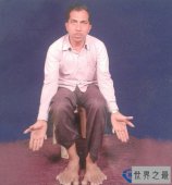 世界之最：印度男子有28根手指脚趾
