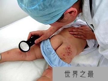 硫酸蚁该如何消灭：人被硫酸蚁咬后怎么处理?