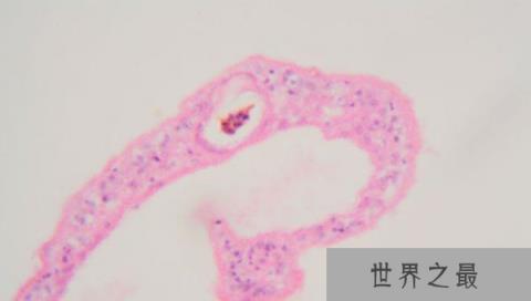 世界十大恶心的寄生虫