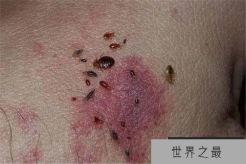 云南十大最毒虫子：螨虫上榜，蚊子排第一