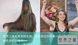 世界上体毛最多的女孩，艾米丽出生时像一个小猴子（体毛多的女孩子）
