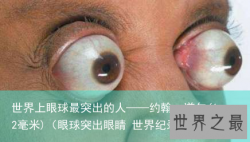 世界上眼球最突出的人——约翰·道尔(12毫米)（眼球突出眼睛 世界纪录）