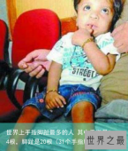 世界上手指脚趾最多的人 其中手指是14根，脚趾是20根（31个手指脚趾）