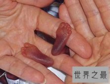 【图】世界上最小的婴儿