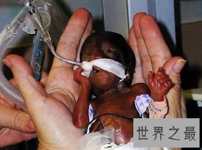 【图】世界上最小的婴儿