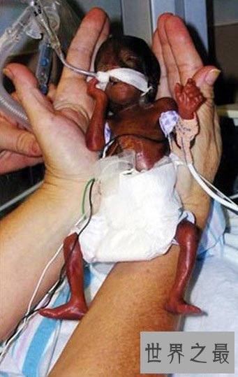 【图】世界上最小的婴儿