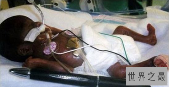 清点世界最小 最小的婴儿竟然只比一支一般圆珠笔长