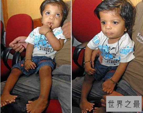 清点世界最多 印度小男孩竟有14个手指和20个脚趾