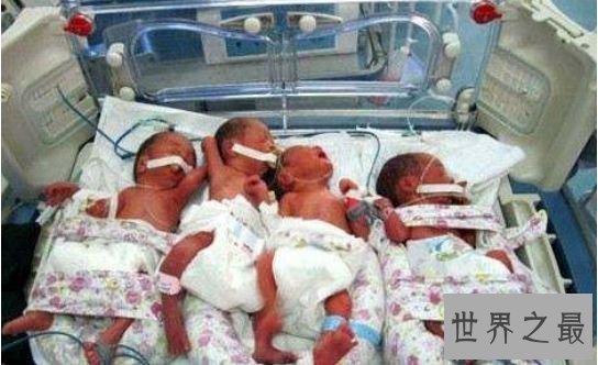 清点世界最多 印度小男孩竟有14个手指和20个脚趾