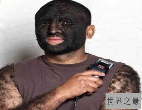 清点世界最多 印度小男孩竟有14个手指和20个脚趾