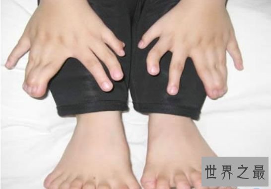 清点世界最多 印度小男孩竟有14个手指和20个脚趾