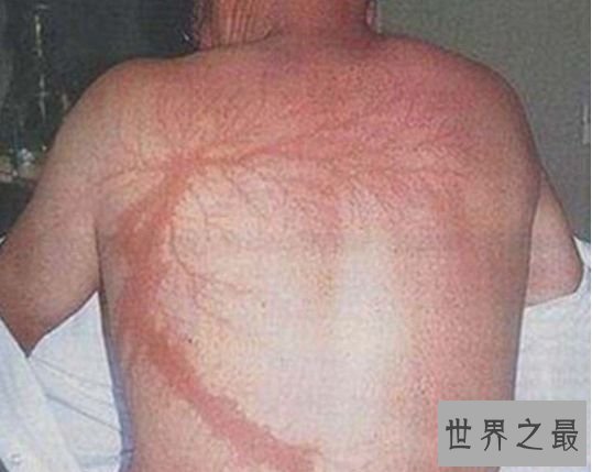 被闪电击中会留下特殊的“漂亮”纹身