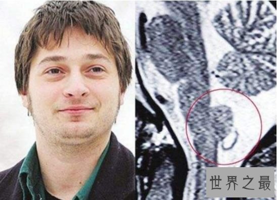 打嗝工夫最长的人，查尔斯.奥斯本每天打嗝24000次(长达68年)