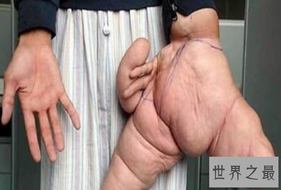 清点世界最大 吉尼斯记载中最大的脚竟长达40厘米