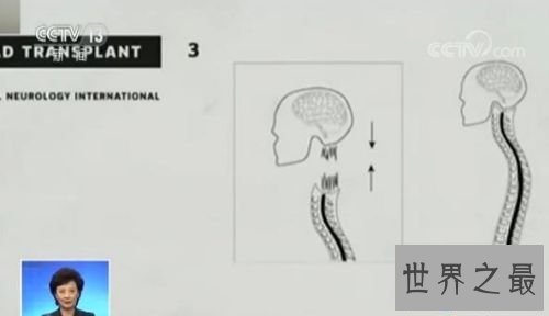 中国传授实现寰球首例人类换头术 历时18个小时