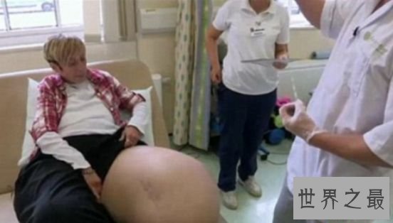 世界上最大最重的腿 英国女子两腿最重达108公斤