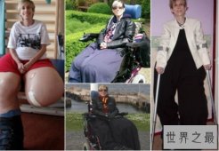 【图】世界上最大最重的腿 英国女子两腿最重达108公斤