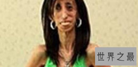 世界上最瘦的人，体重约27公斤