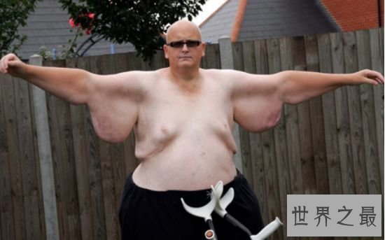 世界上最胖的人 因减掉500斤肉导致皮肤下垂重大