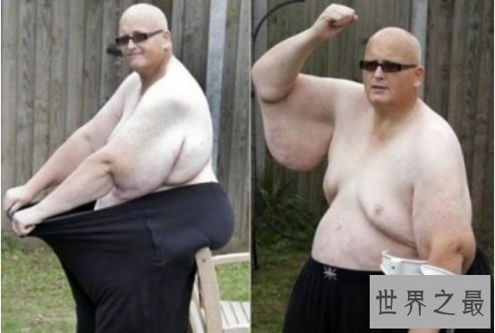 世界上最胖的人 因减掉500斤肉导致皮肤下垂重大