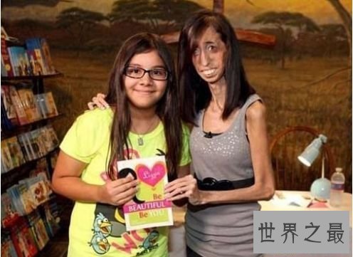 世界上最瘦的人 极其减肥形成体重仅20公斤