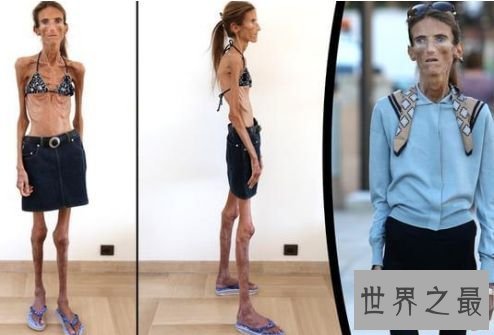 世界上最瘦的人 极其减肥形成体重仅20公斤